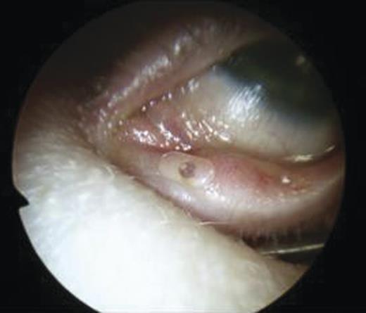 DCR stent fully inserted in the inferior punctum.
