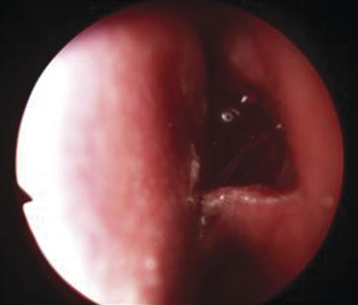 Inferiorly based mucosal flap on the left lateral nasal wall.