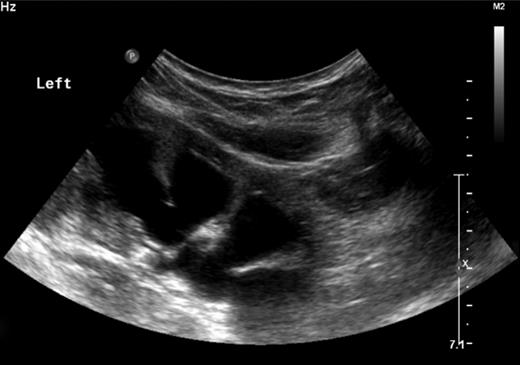 Left renal ultrasound.