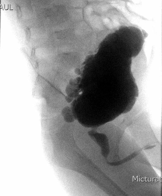 An urgent MCUG showing a markedly trabeculated bladder with dilatation of the posterior urethra.