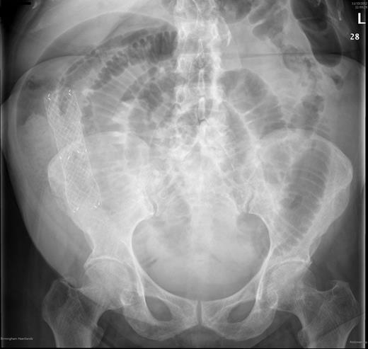 Abdominal X ray taken shortly after presentation. Abdominal films show multiple dilated loops of small bowel with a visible stent in the abdomen.