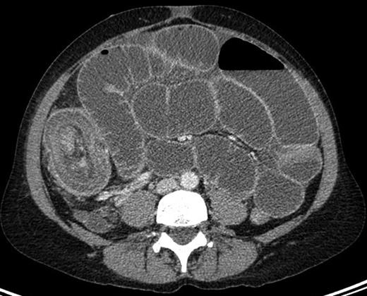 CT image showing the ‘multiple concentric rings’ sign with the central cylinder representing the canal and wall of the intussusceptum; the middle cylinder representing the mesenteric fat and the other cylinder the returning intussusceptum and the intussuscipiens.