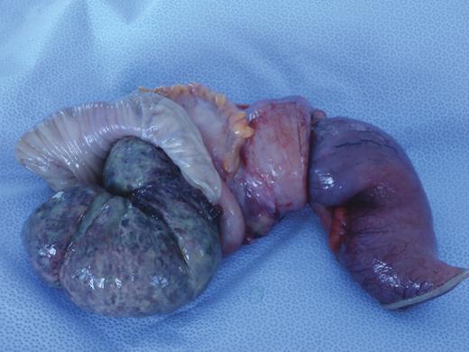 Excised specimen, opened to illustrate ileocolic intussusception.