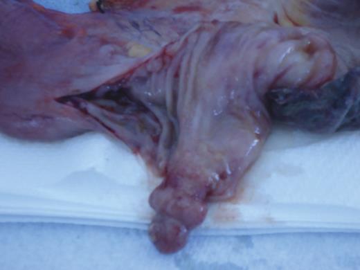 Macroscopic submucosal polypoid lesion at the lead point of intussusception.
