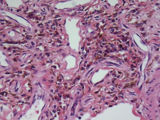 Depicting predominantly submucosa with a proliferation of bland spindle cells together with variably sized vascular channels and a scattered mixed chronic inflammatory cell infiltrate.