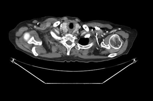 CT scan with the right subpectoral lymph node.