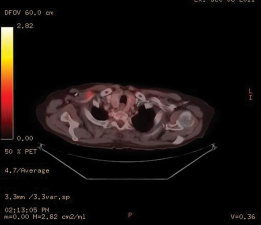 PET-CT scan with the enhancing right subpectoral lymph node.