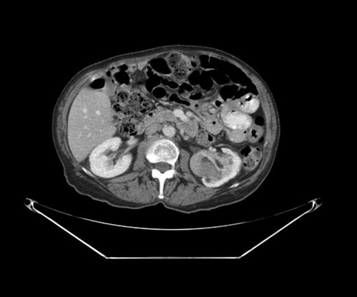 CT scan with the left renal mass.