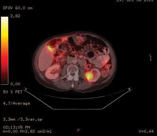 PET-CT scan with the enhancing left renal mass.