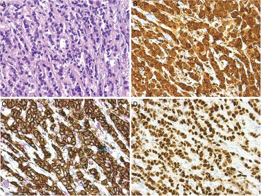 Microscopic findings of the subpectoral lymph node: H&E stain (A, B); E-cadherin and p120 dural stain to confirm the ductal nature of the cancer (C); ER staining (D).