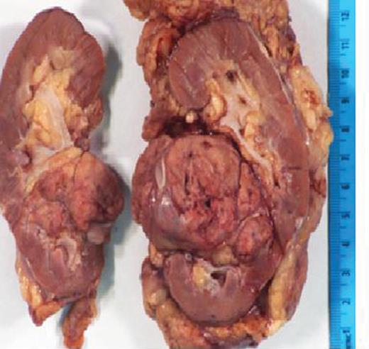 Photograph of the gross specimen, left kidney.