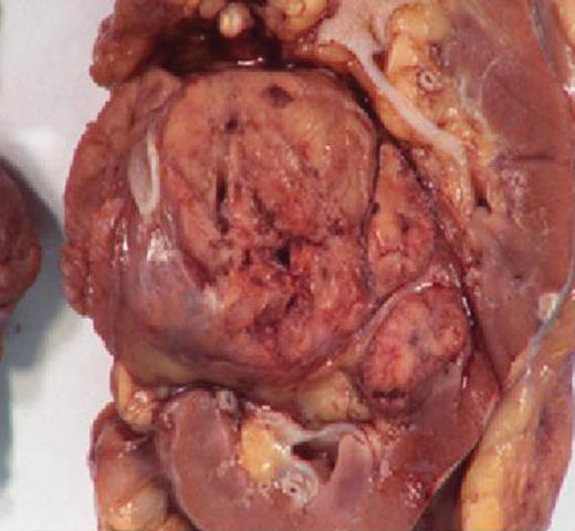 Photograph of the gross specimen, left kidney focusing on tumor.