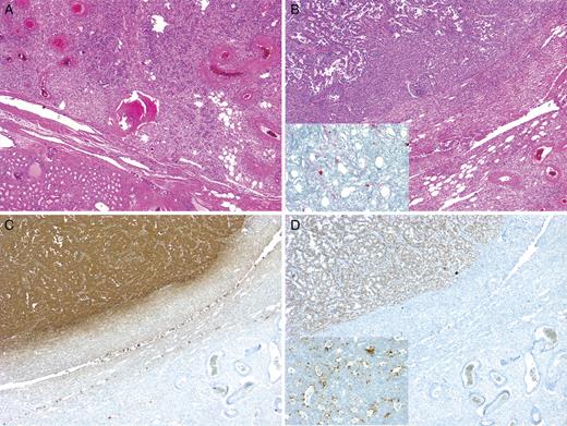 Microscopic findings of left nephrectomy: H&E stain (A, B), with insert in B demonstrating melan A stain to confirm the AML; mammaglobin stain (C); Estrogen receptor stain (D), with insert demonstrating GCDFP15 stain.