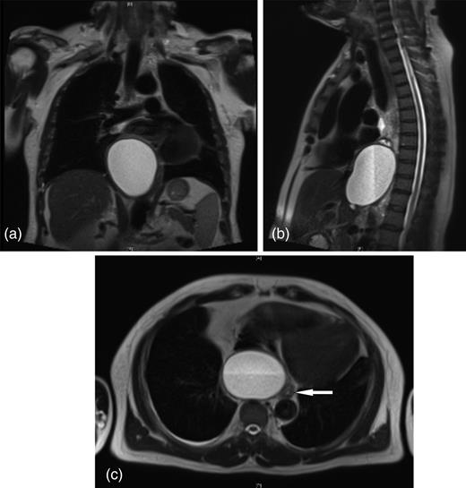 Posterior mediastinal cyst causing displacement of the distal oesophagus extending through the diaphragmatic hiatus into the retroperitoneum (a) coronal (b) sagittal and (c) transverse views (arrow denotes oesophagus).