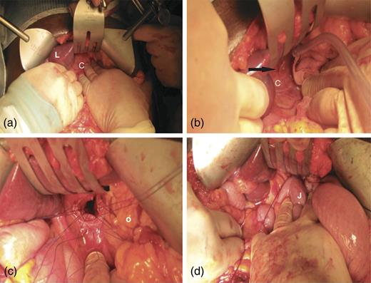 (a) Rooftop laparotomy revealing retroperitoneal cyst emerging though the diaphragmatic hiatus (C, cyst, L, liver). (b) Arrow denotes serous fluid emerging from cyst wall following needle puncture. (c) Opening of cyst below diaphragmatic hiatus with interrupted 2-0 PDS sutures to cyst wall. O, oesophagus. (d) Completed Roux-en-Y cyst-jejunostomy for mediastinal cyst drainage. J, jejunum.