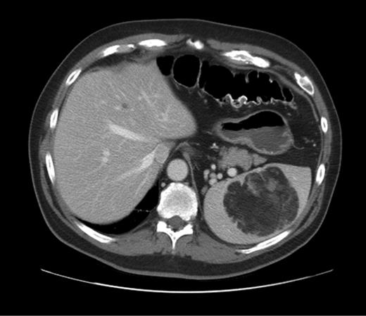 CT abdomen horizontal section with intrasplenic myelolipoma.