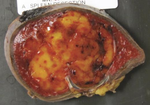 Horizontal section gross pathology of spleen with intrasplenic myelolipoma.