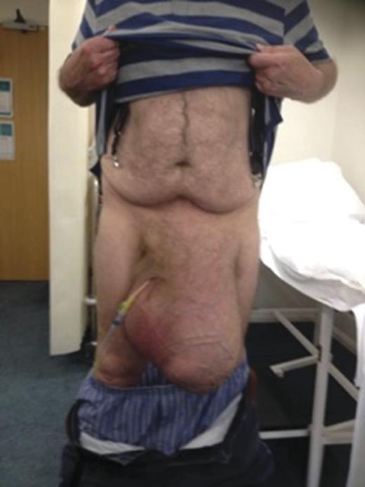 The hernia on patient's first presentation.