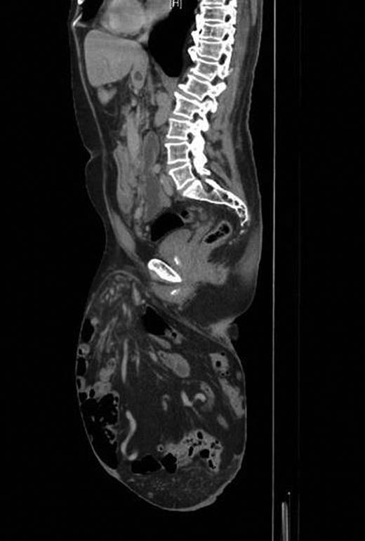 Preoperative CT scan.