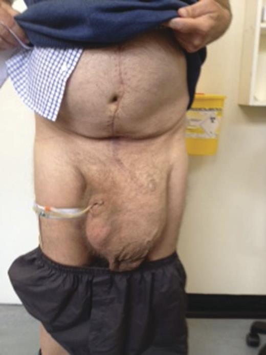 Scrotal seroma 8 weeks postoperatively.