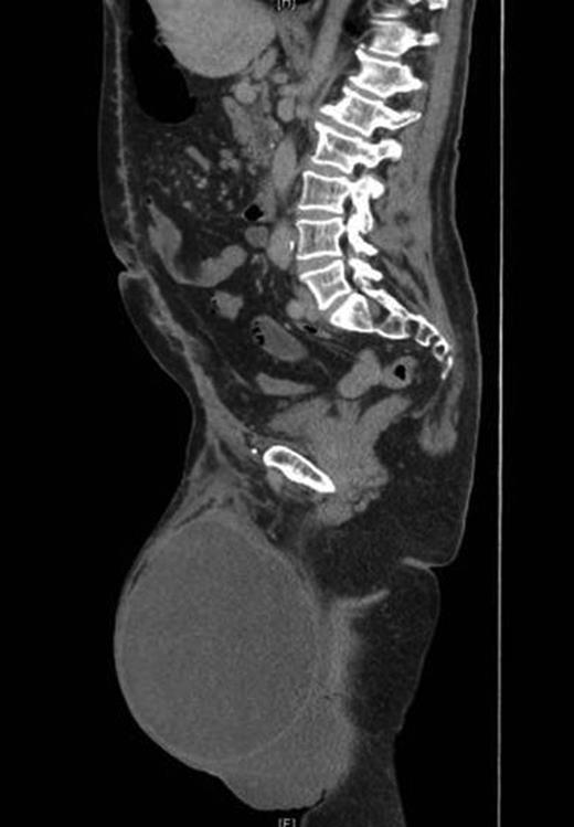 Postoperative CT scan showing intact repair and clear fluid in the scrotum.