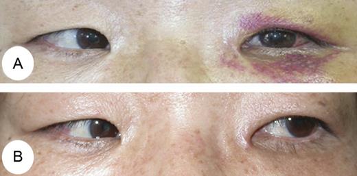 (A) Left ocular movements showed prominent limitation of abduction preoperatively. (B) After surgery, ocular movement was completely improved.