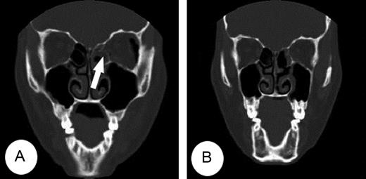 (A) CT showed a trapdoor fracture of the left medial orbital wall with the medial rectus muscle entrapped (arrow) within the fracture. (B) The entrapped medial rectus muscle and fractured medial wall were resolved on post-operative CT.