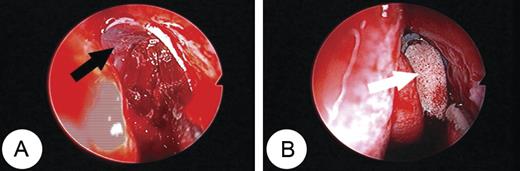 (A) A suitably sized Silastic sheet implant (black arrow) was inserted in an inverse U shape after assessment of ethmoid volume. (B) A piece of Merocel (white arrow) was packed between the Silastic sheets.