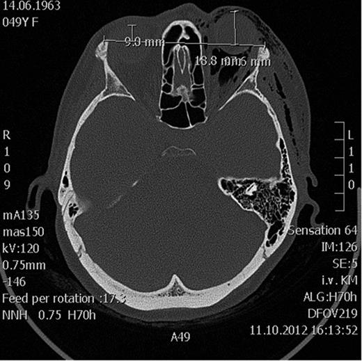 Axial CT scan showing massive emphysema of the orbit leading to proptosis.