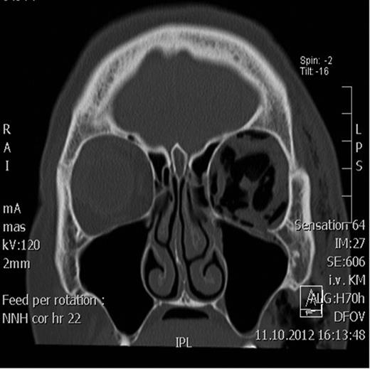 Coronal CT scan showing the retrobulbar emphysema prior to decompression.