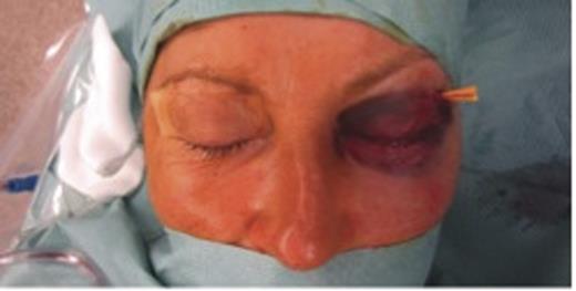 Patient after emergency decompression using blepharoplasty incison.