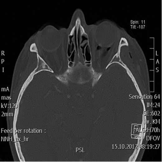 Postoperative axial CT scan showing normal position of the bulbus.