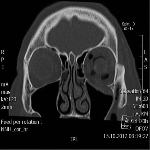 Coronal CT scan after decompression of the orbit.