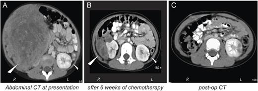 Computed tomography of the patient's abdominal disease at presentation (A), after 6 weeks of chemotherapy per COG AREN0534 (B) and post-surgically (C). (A) Axial abdominal CT image at presentation showing large right-sided renal mass (23 × 13 × 15.8 cm; large triangle) and small contralateral renal lesion (small triangle), (B) Axial abdominal CT after 6 weeks of chemotherapy showing marked response of the right-sided renal tumor (8.6 × 4.1 × 5.3 cm) to therapy. Left-sided renal renal tumor remained approximately stable in size (8 mm) throughout neoadjuvant therapy. (C) Post-surgical abdominal CT reflecting right radical nephrectomy and wedge resection of left kidney.