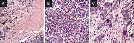 Pathologic images from right-sided lesion after 12 weeks of neoadjuvant chemotherapy. Note that the architecture of the tumor is still well preserved, confirming a diagnosis of Wilms tumor. (A) lower-power power image (×100) showing the area of anaplasia (black triangle) immediately adjacent to an area of scarring and fibrosis (white triangle), (B) a region of non-anaplastic glandular Wilms tumor (×400), (C) anaplastic focus of disease (white triangle; ×400).