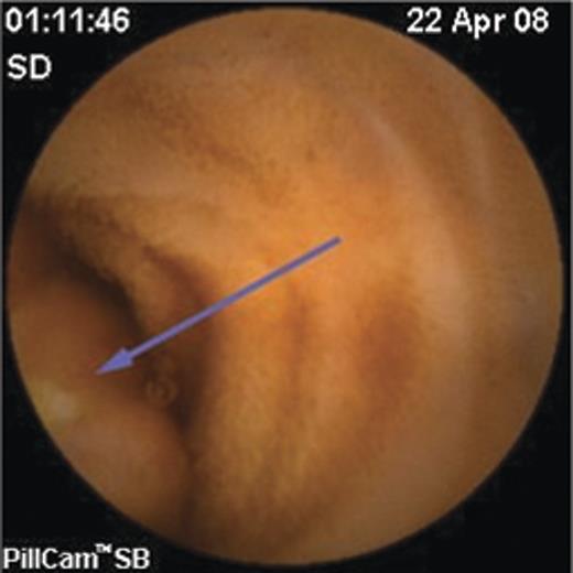 Videocapsule endoscopy image of a submucosal bulge with a superficial ulceration (arrow) in the proximal small intestine.
