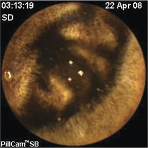 Videocapsule endoscopy image of melena within a more distal small bowel loop.