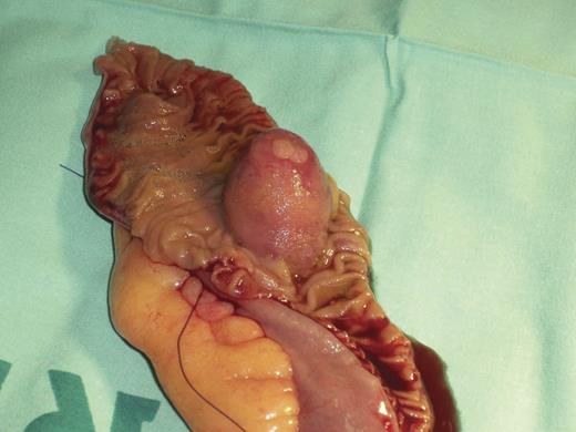 Surgical specimen of a short segment of resected jejunum showing the lipoma with a small superficial ulceration.