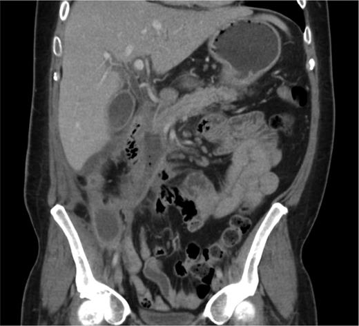 A coronal CT image 12 weeks following his initial presentation with necrotizing pancreatitis; there is atrophy of the pancreatic head and a fluid collection tracks caudally to the right iliac fossa wound. Small bubbles of gas are also seen within the fluid collection. The pancreatic duct is visible and of normal calibre.