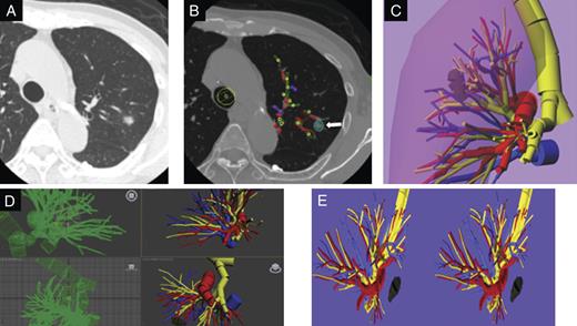 (A) Chest CT image shows a primary lesion as ground glass opacity in 2 segments (S1 + 2 and S3) of the left upper division. (B) Locations and thicknesses of tumor. Yellow dots indicate the bronchi; red dots, the pulmonary arteries; blue dots, the pulmonary veins; white, tumor, which were rendered as different-sized cylinders by the home-made software program (CTTRY). The striped rectangles of each color were a trace of the dots of each color. (C) Virtual 3-D image was reconstructed using shareware (Metasequoia). Yellow indicates the trachea and bronchi; red, pulmonry arteries; blue, pulmonary veins; the veiled area, the lung. (D) Data of the reconstructed 3-D images were converted with Autodesk® 3ds Max® 2012. (E) REMO Exporter®, which reproduces Autodesk 3ds Max data with real-time CG, can indicate with a stereoscopic vision display by 3-DCG data. On a PC, reconstructed 3-D pulmonary images were provided side-by-side and were output to a monitor. Dark yellow indicates the stapled bronchi; dark blue, resected pulmonary veins.