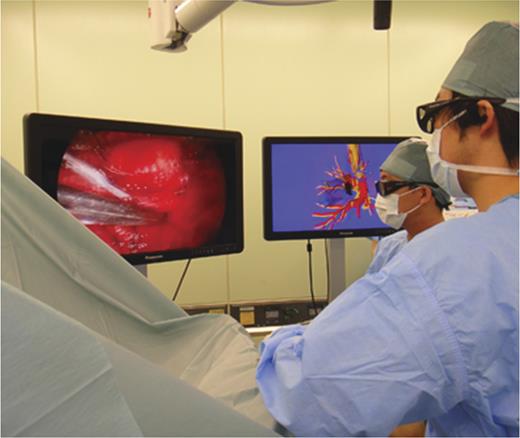 In 3-D thoracoscopic surgery with 3-D navigation, wearing glasses, comparing 3-D intraoperative field during VATS and the picture of 3-D reconstructed pulmonary model, with 3-D LC displays, the surgeons performed thoracoscopic procedures.