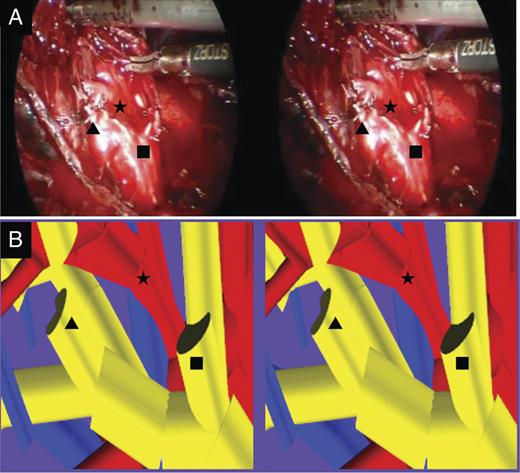 Comparison between the 3-D navigation of patient-specific 3-D reconstructed pulmonary model and the operative view. (A) The operative view of the patient was extracted from digital video data taken during the operation and was provided on a PC after operation. (B) In patient-specific 3-D image, the target bronchus and vascular branching pattern were similar to intraoperative findings. B1 + 2c (Filled Square) and B3a (Filled Triangle) were dissected and stapled separately. A1 + 2c (Filled Star) was detected.