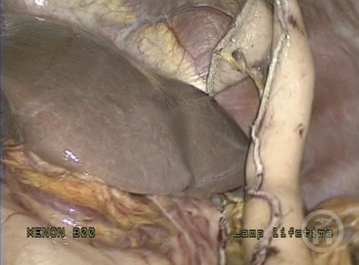 Gastric tube.