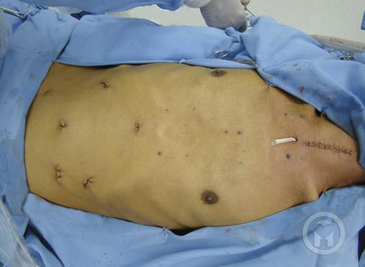 Patient after surgery.