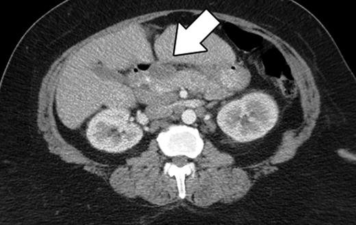 CT scan (demonstrating pancreatic head lesion).
