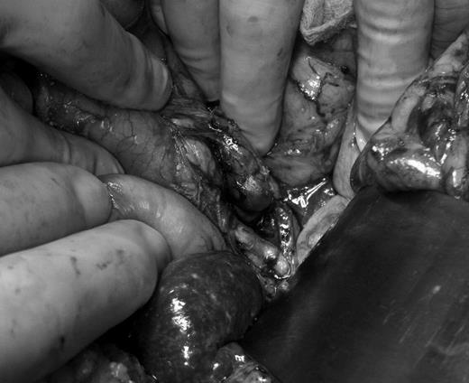 Peripancreatic mass, in situ.