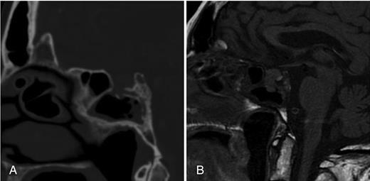 (A) Initial CT scan indicating dehiscence of the floor of the sella and mucoperiosteal thickening in the sphenoid sinus with curvilinear calcification. (B) Initial T1-weighted MRI, indicating a pituitary fossa mass communicating with the superior aspect of the sphenoid sinus.