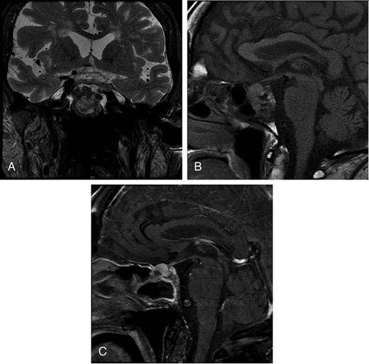 MRI performed 3 weeks after initial presentation. (A) T2-weighted MRI coronal section displaying an expanding, infiltrative pituitary fossa mass. (B) T1-weighted MRI sagittal view, indicating that the lesion is locally infiltrating the sphenoidal sinus. (C) Post-gadolinium sagittal T1-weighted MRI indicating a heterogeneously enhancing mass.