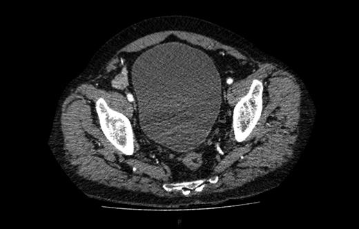 The initial CT scan of the abdomen showing a large distended bladder.