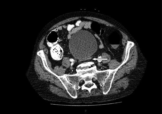 Further image of the same CT scan showing compression of the sigmoid colon against the sacral promontory (see arrow) behind the distended bladder.